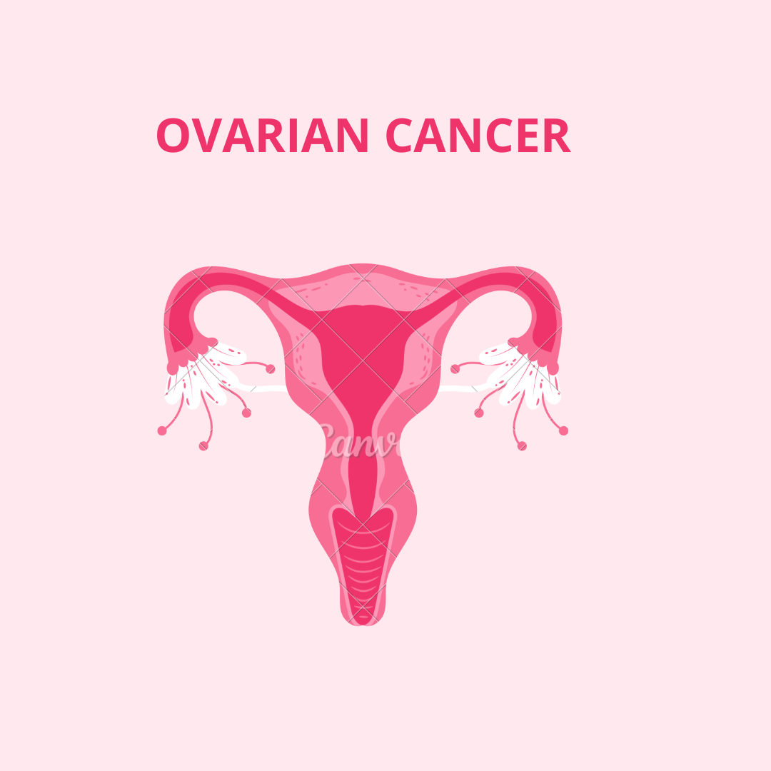 Ovarian cancer- Everything you need to know.